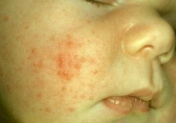 Parasites under a child's skin